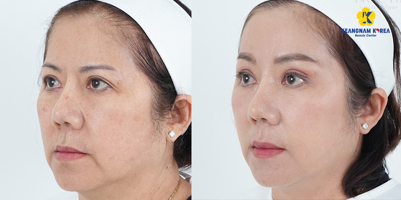 Căng da mặt có đau không? Bao lâu hết đau & hồi phục? Lưu ý trước và sau khi làm là gì? 2 căng da mặt có đau không