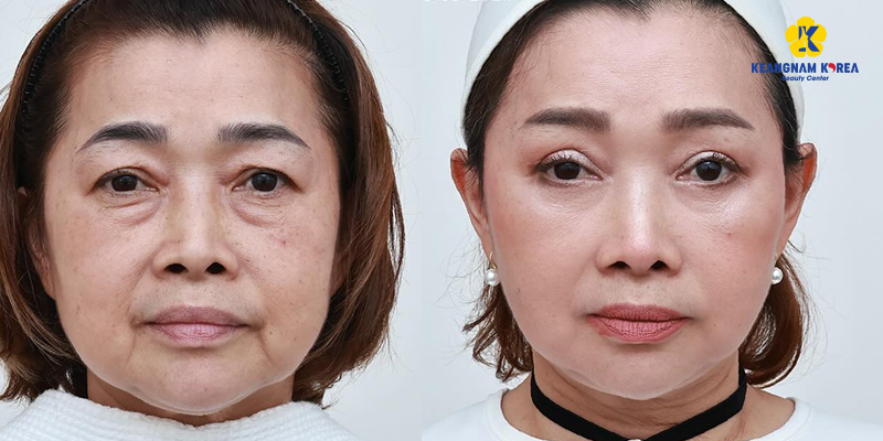 Căng da mặt có đau không? Bao lâu hết đau & hồi phục? Lưu ý trước và sau khi làm là gì? 5 căng da mặt có đau không