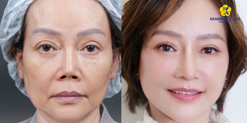 Cập nhật chi phí căng da mặt mới nhất hiện nay 3 chi phí căng da mặt mới nhất