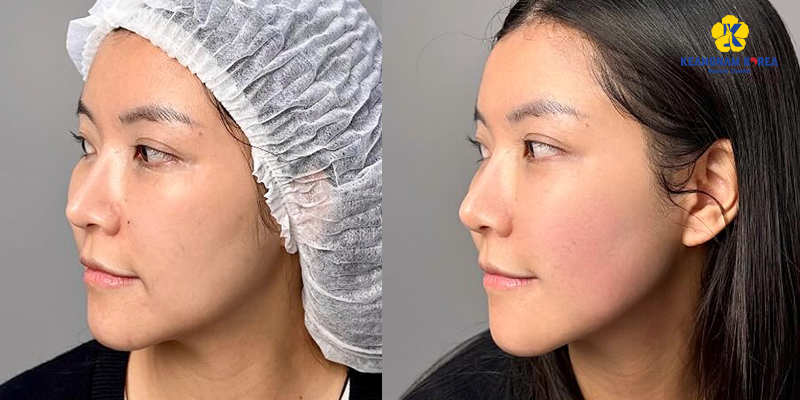 Hình ảnh căng da mặt bằng chỉ và hiệu quả thực tế khi thực hiện tại Keangnam Korea 2 hình ảnh căng da mặt bằng chỉ