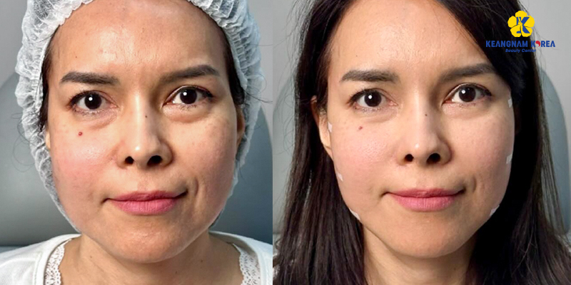 Hình ảnh căng da mặt bằng chỉ và hiệu quả thực tế khi thực hiện tại Keangnam Korea 3 hình ảnh căng da mặt bằng chỉ