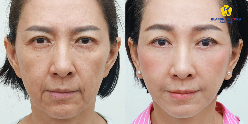 Hình ảnh căng da mặt bằng chỉ và hiệu quả thực tế khi thực hiện tại Keangnam Korea 4 hình ảnh căng da mặt bằng chỉ