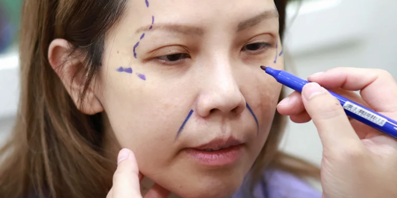 Hình ảnh căng da mặt bằng chỉ và hiệu quả thực tế khi thực hiện tại Keangnam Korea 5 hình ảnh căng da mặt bằng chỉ