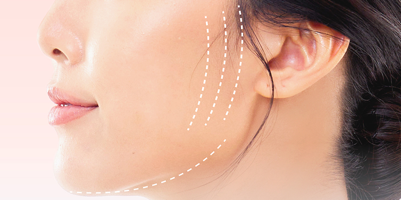 Hình ảnh căng da mặt bằng chỉ và hiệu quả thực tế khi thực hiện tại Keangnam Korea 1 hình ảnh căng da mặt bằng chỉ