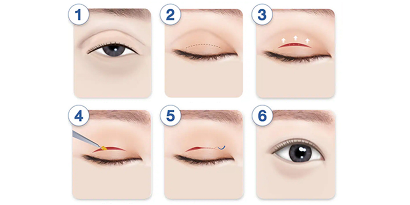 Cắt mí có mấy loại? 5 phương pháp cắt mí hiện đại nhất 3 mo phong mini deep