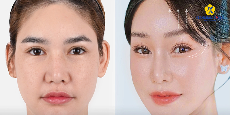 Nâng cung chân mày không phẫu thuật là gì? Có bền không? Dành cho ai? Giá bao nhiêu? 2 nâng cung chân mày không phẫu thuật