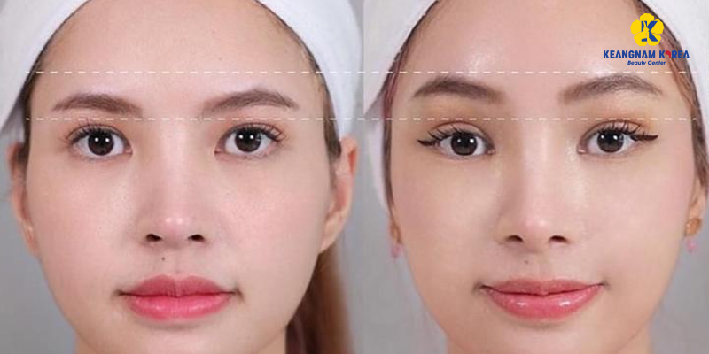 Nâng cung chân mày không phẫu thuật là gì? Có bền không? Dành cho ai? Giá bao nhiêu? 3 nâng cung chân mày không phẫu thuật