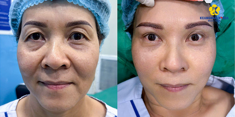 Nâng cung mày bao lâu thì hết sẹo? 4 nâng cung mày bao lâu thì hết sẹo