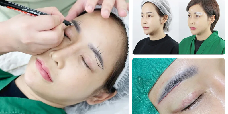 Nâng cung mày bao lâu thì hết sẹo? 3 nâng cung mày bao lâu thì hết sẹo