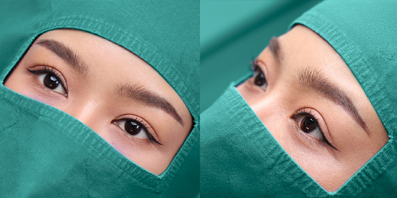 nhấn mí có được lâu không