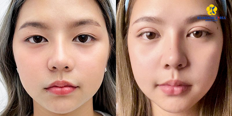 nhấn mí có được lâu không