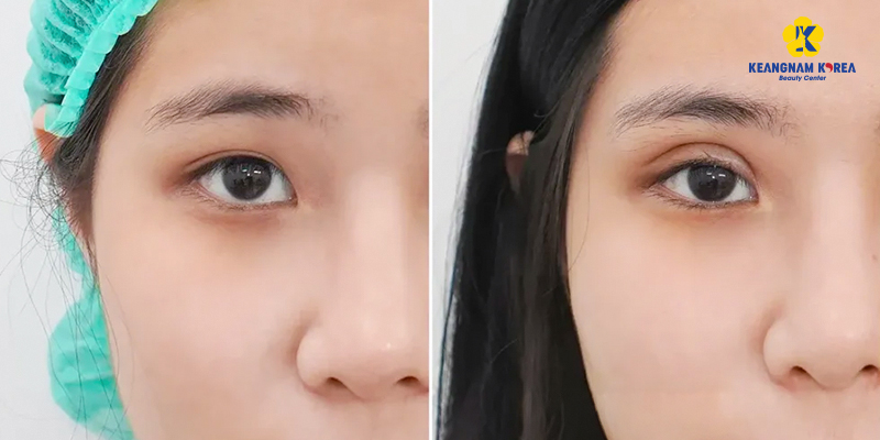 nhấn mí có được lâu không