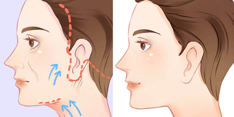 Căng da mặt có đau không? Bao lâu hết đau & hồi phục? Lưu ý trước và sau khi làm là gì? 4 căng da mặt có đau không