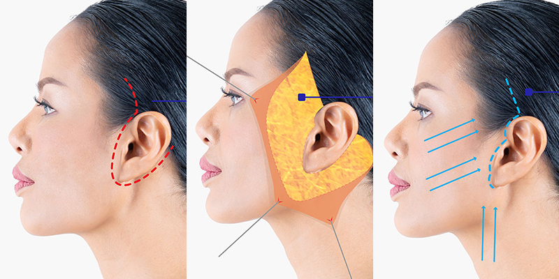 So sánh tiểu phẫu căng da mặt và căng da mặt toàn phần: lựa chọn nào phù hợp? 3 căng da mặt toàn phần