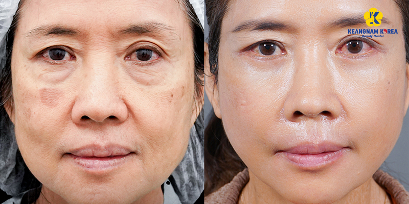 Tổng hợp 5 địa chỉ phẫu thuật thẩm mỹ căng da mặt uy tín tại Sài Gòn 3 phẫu thuật thẩm mỹ căng da mặt