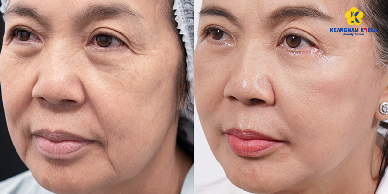 Tổng hợp 5 địa chỉ phẫu thuật thẩm mỹ căng da mặt uy tín tại Sài Gòn 4 phẫu thuật thẩm mỹ căng da mặt