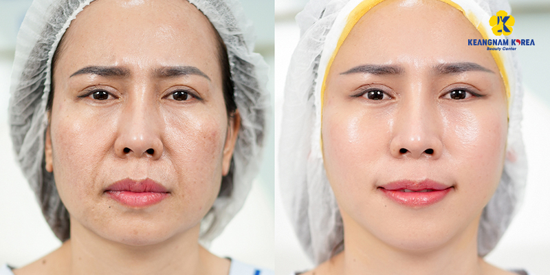 Tổng hợp 5 địa chỉ phẫu thuật thẩm mỹ căng da mặt uy tín tại Sài Gòn 2 phẫu thuật thẩm mỹ căng da mặt