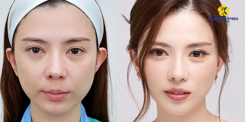 Phẫu thuật thẩm mỹ kéo căng da mặt: phương pháp, quy trình, chi phí, ưu nhược điểm là gì 5 phẫu thuật thẩm mỹ kéo căng da mặt