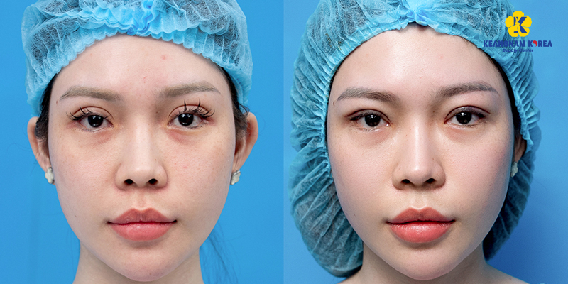 Cắt mí có mấy loại? 5 phương pháp cắt mí hiện đại nhất 4 phuong phap cat mi hien dai nhat 1