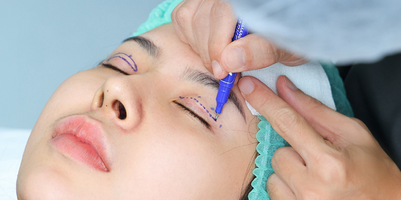 Cắt mí có mấy loại? 5 phương pháp cắt mí hiện đại nhất 2 phương pháp cắt mí hiện đại nhất hiện nay