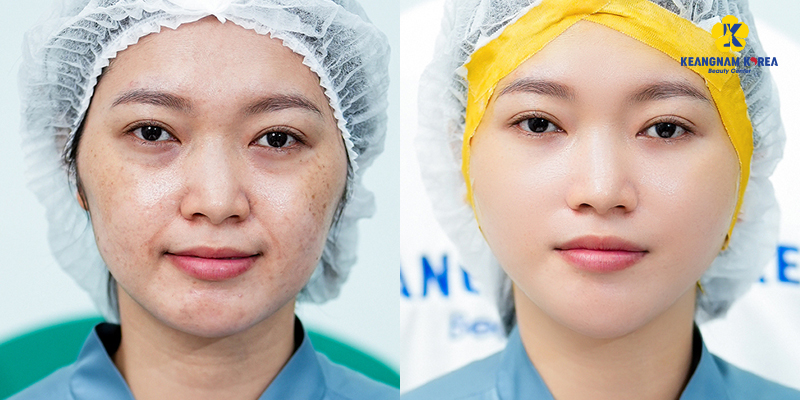 Tiêm trị thâm mắt có an toàn không