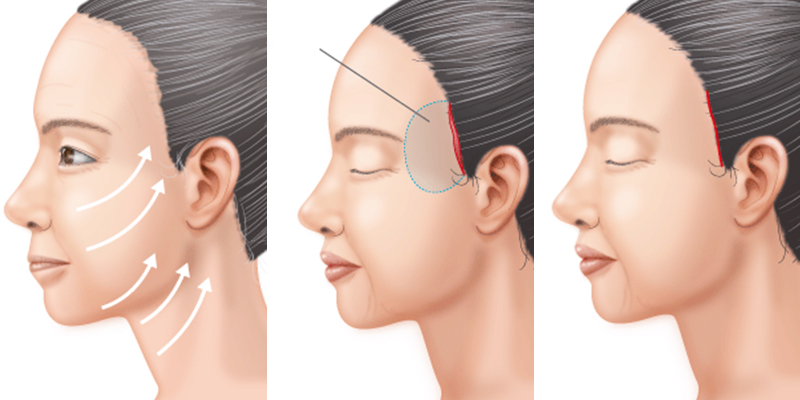 So sánh tiểu phẫu căng da mặt và căng da mặt toàn phần: lựa chọn nào phù hợp? 2 tiểu phẫu căng da mặt