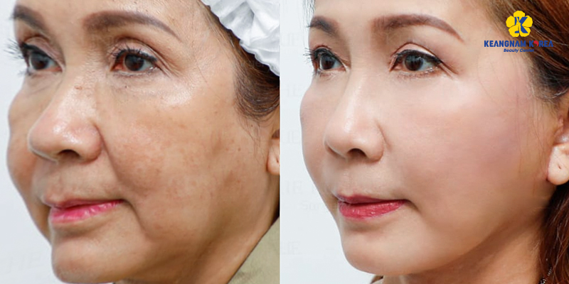 So sánh tiểu phẫu căng da mặt và căng da mặt toàn phần: lựa chọn nào phù hợp? 4 tiểu phẫu căng da mặt