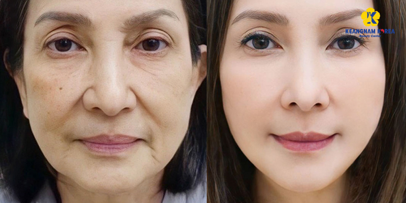 So sánh tiểu phẫu căng da mặt và căng da mặt toàn phần: lựa chọn nào phù hợp? 5 tiểu phẫu căng da mặt