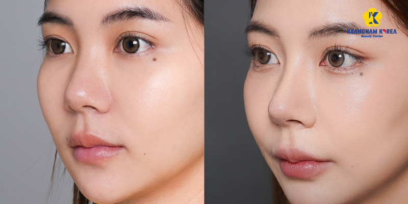 Nâng mũi bằng phương pháp nào an toàn nhất? 8 Nâng mũi Hàn Quốc