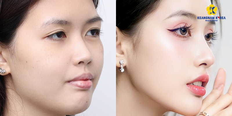 Nâng mũi bằng phương pháp nào an toàn nhất? 7 Nâng mũi Sụn sườn tự thân