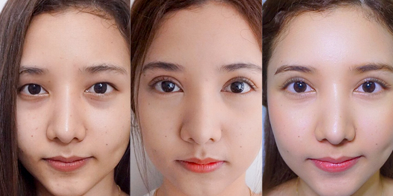 Bấm mí hay cắt mí đẹp hơn? Có nên bấm mí mắt không? 2 Bấm mí mắt là gì