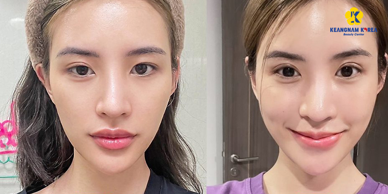 Bấm mí mắt hàn quốc ở đâu đẹp? Top 5 địa chỉ bấm mí đẹp tại TP.HCM 3 bấm mí mắt hàn quốc ở đâu đẹp