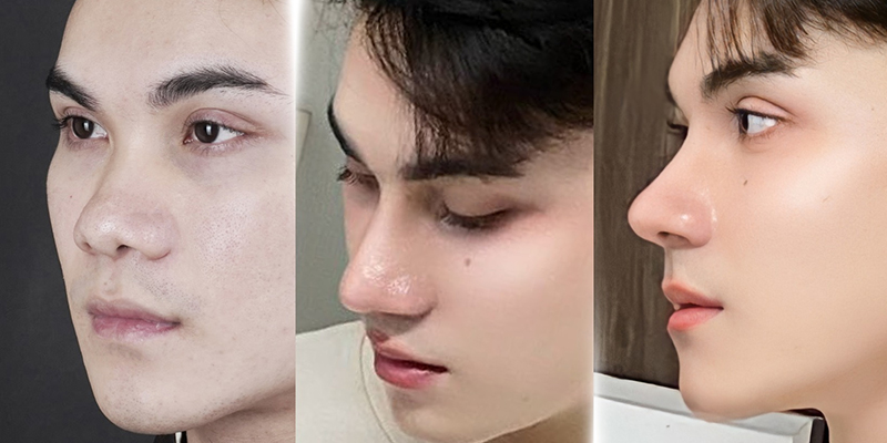 Nâng mũi nam giới có những kiểu nào? Ở đâu tốt? Giá bao nhiêu? 2 Nâng mũi nam giới có những kiểu nào