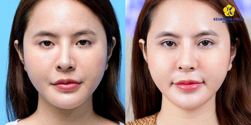 Cắt mắt 2 mí giá bao nhiêu tiền? Bảng giá & Yếu tố ảnh hưởng chi phí 4 Cắt mắt 2 mí giá bao nhiêu tiền