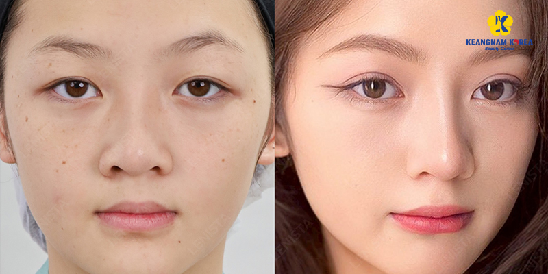 Mắt 2 mí lót là gì? Đẹp hay xấu? Mắt mí lót có ý nghĩa gì trong tướng số nam và nữ? 4 Mắt 2 mí lót