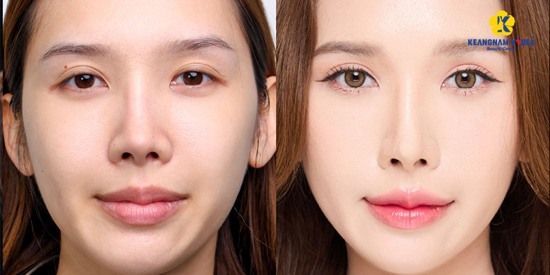 Cắt mí mắt có thay đổi vận mệnh không? 5 cắt mí mắt có thay đổi vận mệnh không