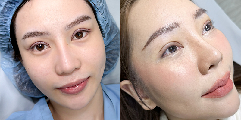 Có nên cắt mí mắt hay không? 3 có nên cắt mí mắt hay không