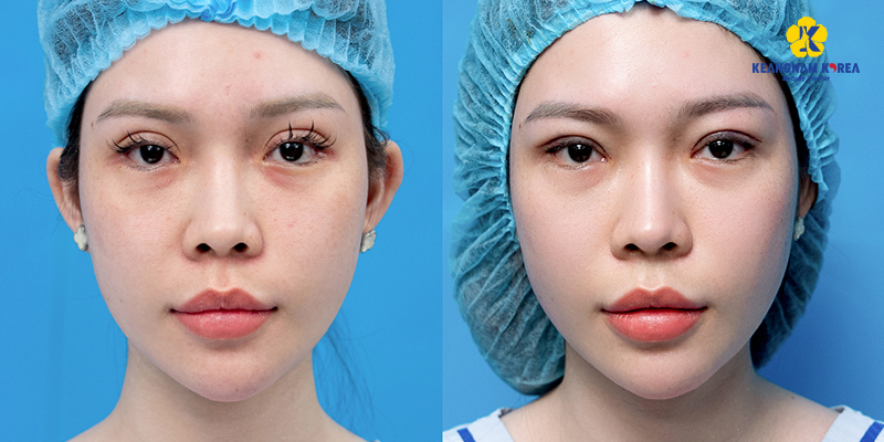 Có nên cắt mí mắt hay không? 6 có nên cắt mí mắt hay không