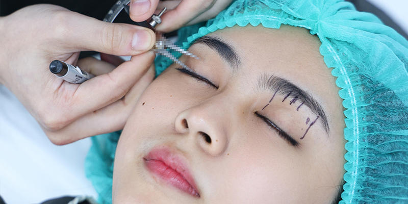 Có nên cắt mí mắt hay không? 5 có nên cắt mí mắt hay không