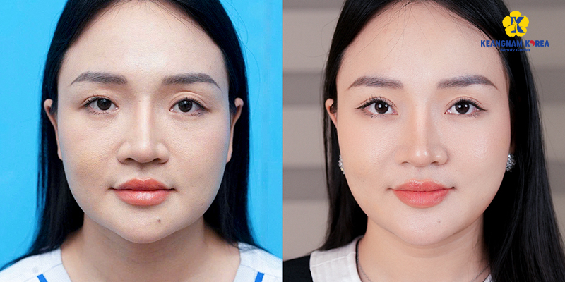 Có nên cắt mí mắt hay không? 7 có nên cắt mí mắt hay không