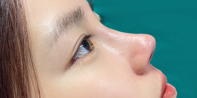 Nâng mũi bao lâu thì đầu mũi hết to? 2 nâng mũi bao lâu thì đầu mũi hết to