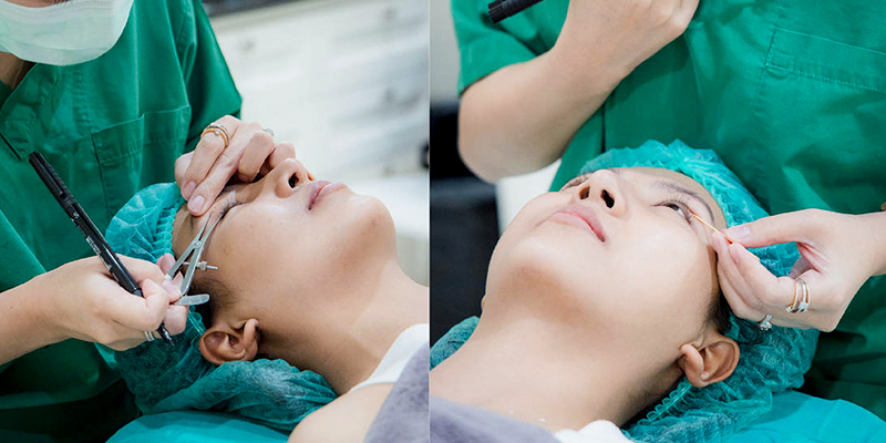 How Much Is Double Eyelid Surgery in Vietnam? Blepharoplasty Cost & Best Clinics 2026 2 double eyelid surgery cost