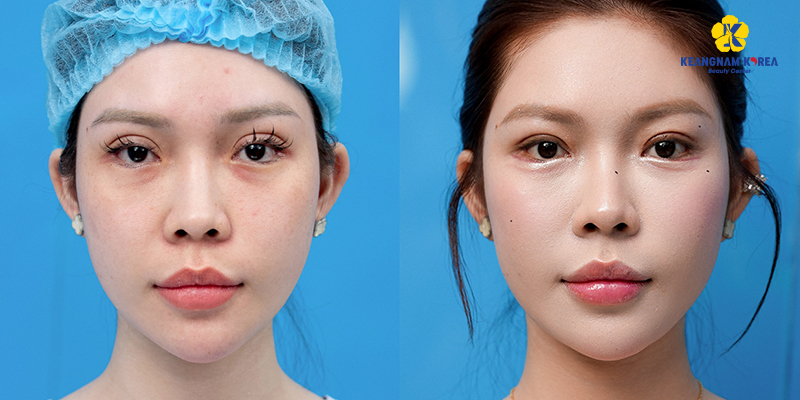 How Much Is Double Eyelid Surgery in Vietnam? Blepharoplasty Cost & Best Clinics 2026 3 double eyelid surgery cost