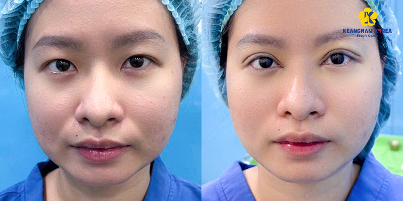 Mắt 1 mí rưỡi là gì? Cách biến mắt mí rưỡi thành mắt 2 mí đẹp tự nhiên 4 Mắt 1 mí rưỡi là gì?