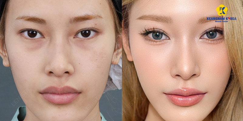 Mắt 2 mí lót là gì? Đẹp hay xấu? Mắt mí lót có ý nghĩa gì trong tướng số nam và nữ? 3 cắt mí cho mắt 2 mí lót