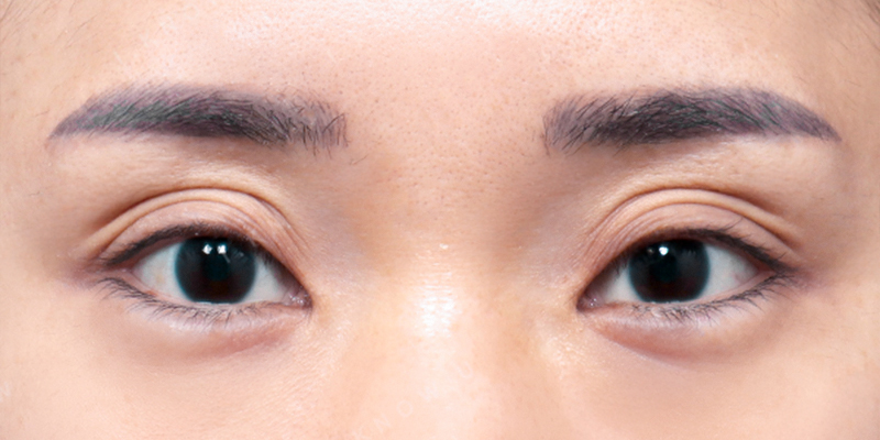 Mắt 3 mí là sao? Cách khắc phục và làm mắt 3 mí thành 2 mí 2 mắt 3 mí là gì