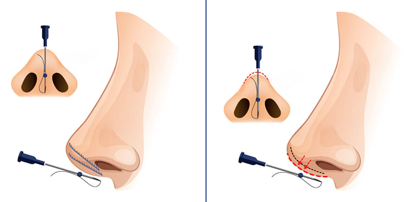 Nâng mũi chỉ sinh học là gì? Có tốt không? 2 nâng mũi chỉ sinh học là gì