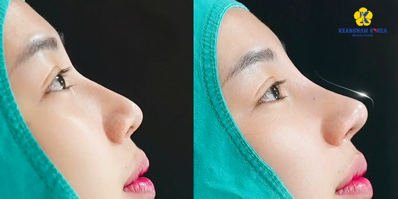 Nâng mũi bằng phương pháp nào an toàn nhất? 3 nâng mũi bằng phương pháp nào an toàn nhất