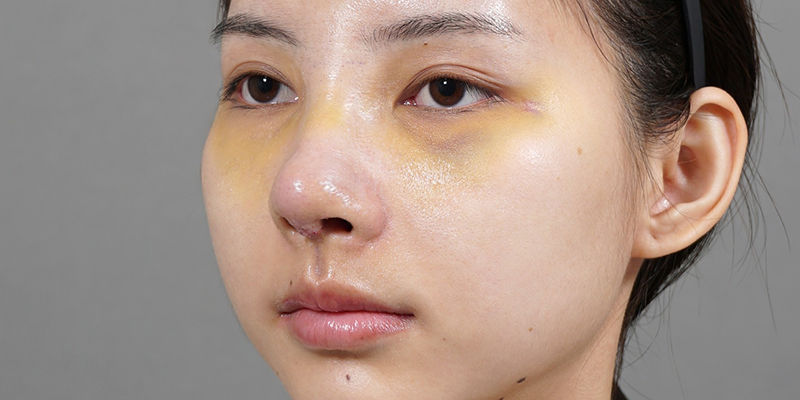 Nâng mũi bao lâu thì đầu mũi hết to? 3 nâng mũi bao lâu thì đầu mũi hết to