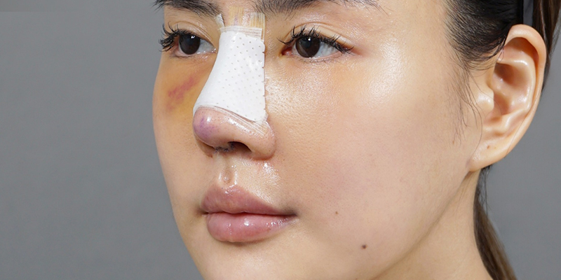 Nâng mũi bao lâu thì đầu mũi hết to? 5 nâng mũi bao lâu thì đầu mũi hết to